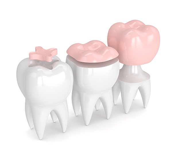 Plano Dental Inlays and Onlays