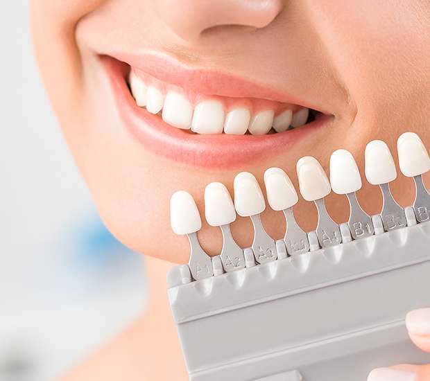 Plano Dental Veneers and Dental Laminates